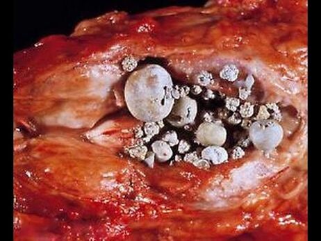 Prostatite chalcolithique